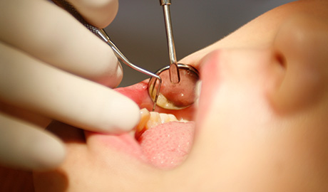 舌の常在菌バランスを検査